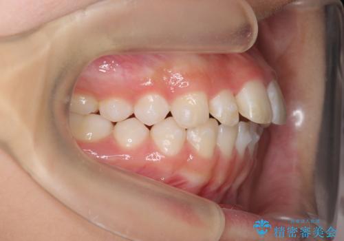 [ 出っ歯を治したい ]   マウスピース矯正での上顎前突治療の治療中