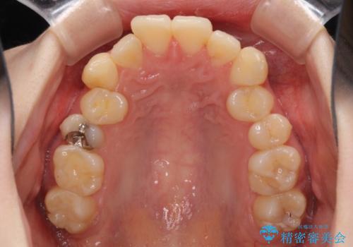 デコボコ歯列をきれいに インビザラインによる矯正治療の治療前