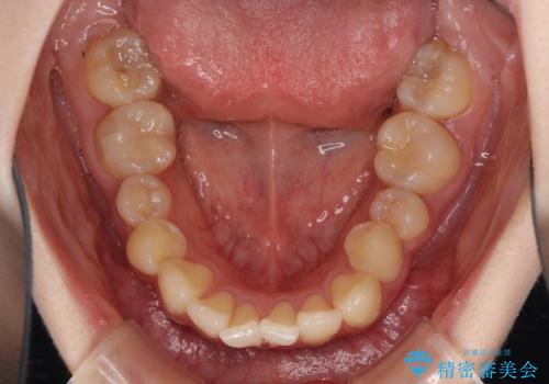 デコボコ歯列をきれいに インビザラインによる矯正治療の治療前
