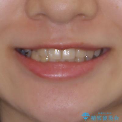 楽してクロスバイトを治したい ワイヤー装置による矯正治療の治療前(顔貌)