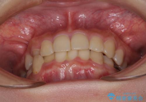 楽してクロスバイトを治したい ワイヤー装置による矯正治療の治療前