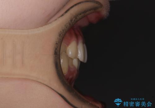 楽してクロスバイトを治したい ワイヤー装置による矯正治療の治療前