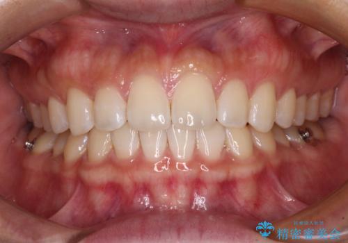 【モニター】前歯のすきっ歯をインビザラインで改善の治療中