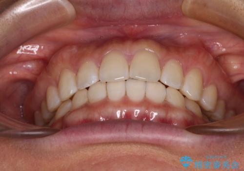 【モニター】前歯のすきっ歯をインビザラインで改善の治療中