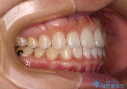 【モニター】前歯のすきっ歯をインビザラインで改善の治療中