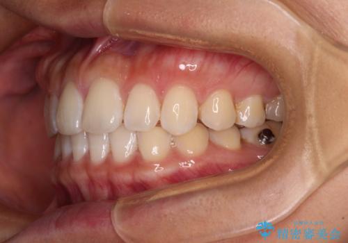 【モニター】前歯のすきっ歯をインビザラインで改善の治療中