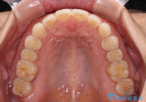 【モニター】前歯のすきっ歯をインビザラインで改善の治療中