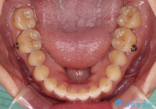 【モニター】前歯のすきっ歯をインビザラインで改善の治療中