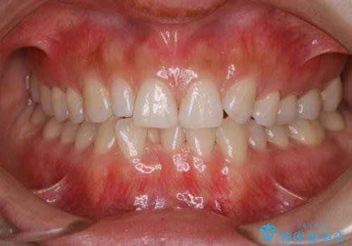 5、6年ぶりのクリーニング(PMTC)の症例 治療後