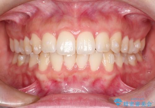 前歯のがたつきをインビザラインで目立たない矯正の治療中