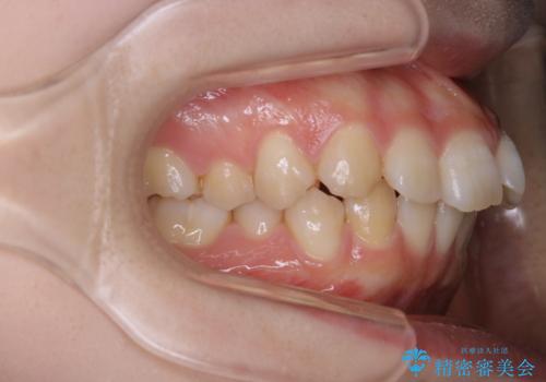 前歯の重なりは奥歯のズレが原因:まとめてインビザラインで治すの治療前