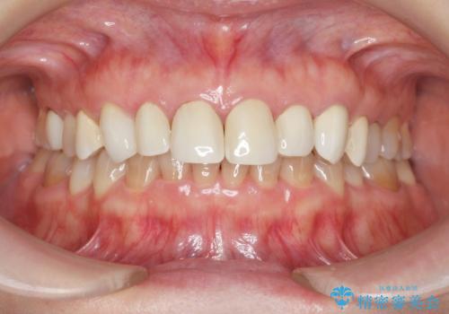 劣化してきた前歯ラミネートをジルコニアクラウンへの治療前