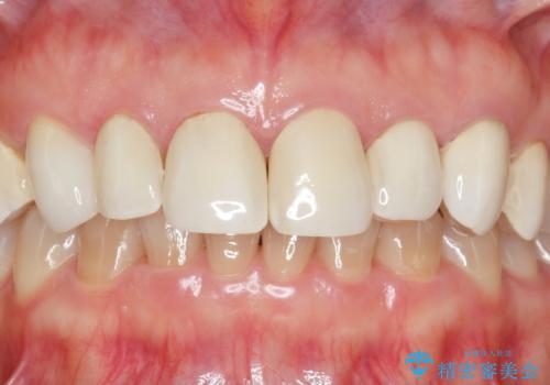 劣化してきた前歯ラミネートをジルコニアクラウンへの治療前