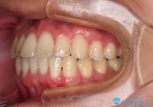 【モニター】前歯のクロスバイトと隙間を改善 インビザラインによる矯正治療の治療後