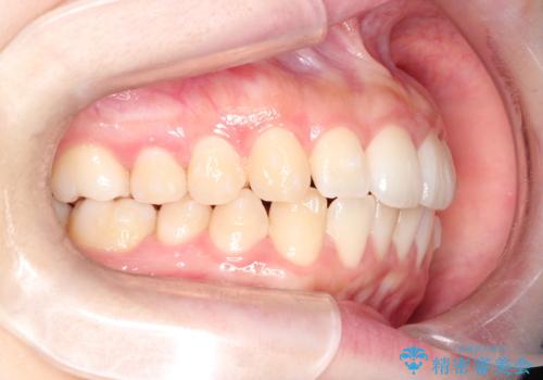 前歯のがたつきをインビザラインで目立たない矯正の治療中