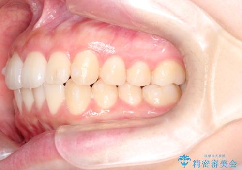 前歯のがたつきをインビザラインで目立たない矯正の治療中