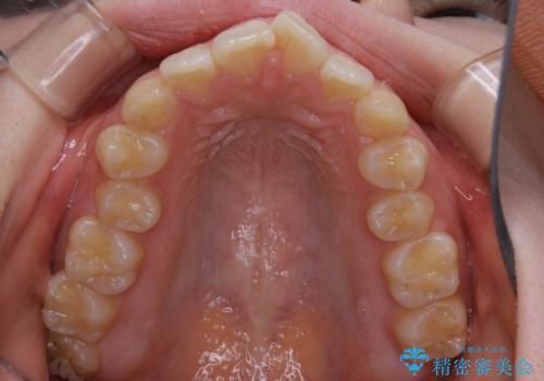 前歯の重なりは奥歯のズレが原因:まとめてインビザラインで治すの治療前