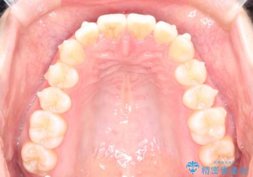 前歯のがたつきをインビザラインで目立たない矯正の治療中