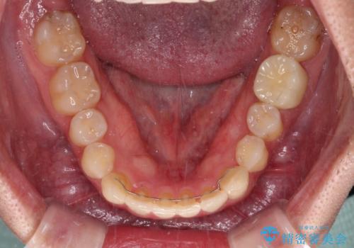 【モニター】前歯のクロスバイトと隙間を改善　インビザラインによる矯正治療の治療後