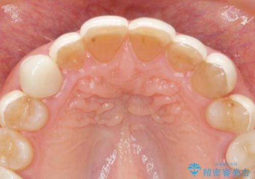 劣化してきた前歯ラミネートをジルコニアクラウンへの治療前