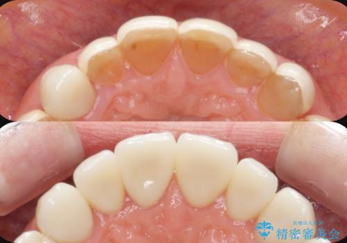 劣化してきた前歯ラミネートをジルコニアクラウンへ