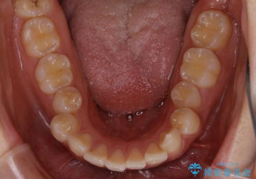 前歯の重なりは奥歯のズレが原因:まとめてインビザラインで治すの治療前