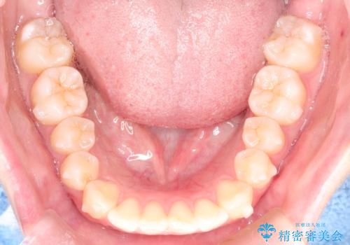 前歯のがたつきをインビザラインで目立たない矯正の治療中