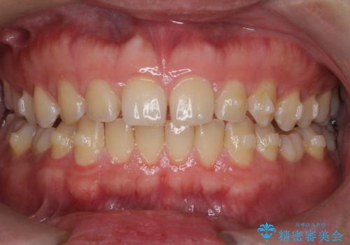 エアーフローで黄ばみ取りの治療前