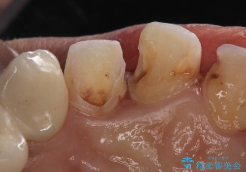 つぎはぎの前歯をセラミックにしたいの治療中