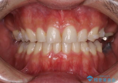 PMTC30分コース インビザラインの矯正中の症例 治療前