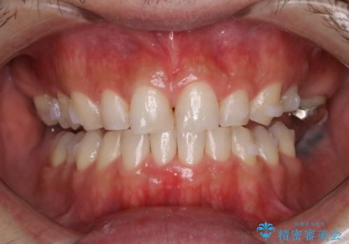 PMTC30分コース インビザラインの矯正中の症例 治療後