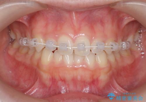 前歯のガタつきを改善　マウスピース矯正とワイヤー部分矯正の治療中