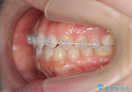 前歯のガタつきを改善　マウスピース矯正とワイヤー部分矯正の治療中
