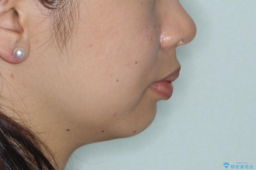 出っ歯の矯正 抜歯をしてしっかり引っ込めるワイヤー矯正の治療前(顔貌)