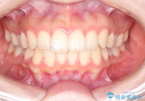 前歯のがたつきをインビザラインで目立たない矯正の治療前