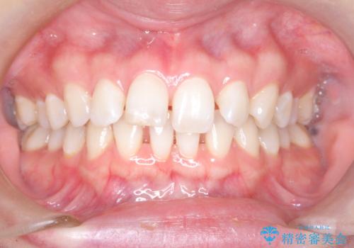 すきっ歯をインビザラインで目立たたずストレスなく矯正の症例 治療前