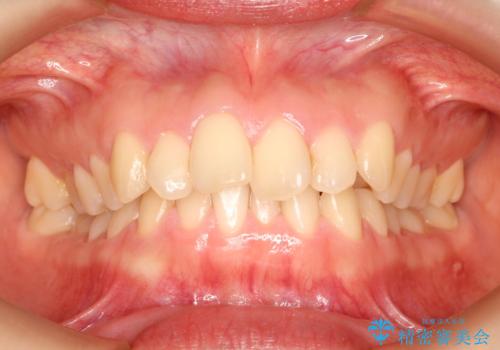 【出っ歯(飛び出した前歯)・がたつきでお悩みの方必見】インビザライン矯正の症例の症例 治療前