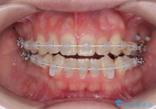 八重歯と前歯の欠損と骨格のズレ　目立たないワイヤー矯正の治療中