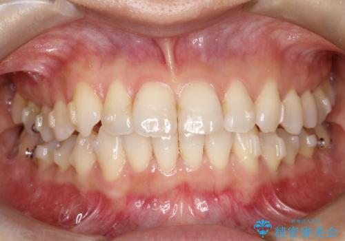 八重歯と前歯のガタガタをインビザラインでの治療中
