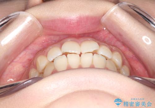 前歯のがたつきをインビザラインで目立たない矯正の治療前