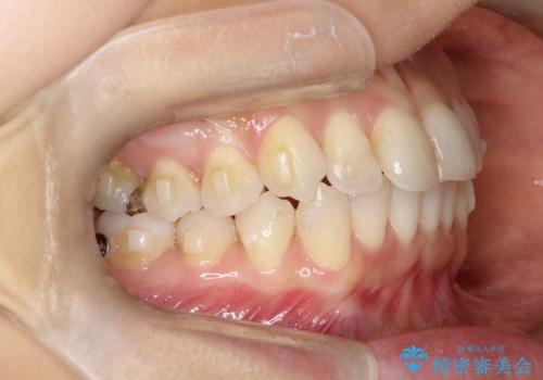 八重歯と前歯のガタガタをインビザラインでの治療中
