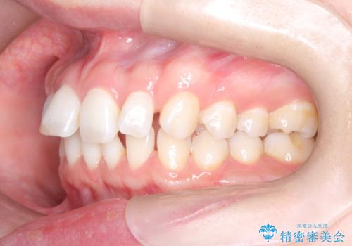 すきっ歯をインビザラインで目立たたずストレスなく矯正の治療前