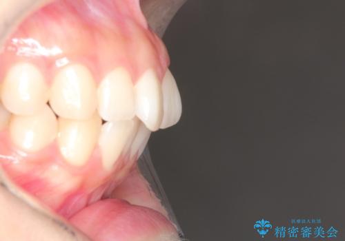 前歯のがたつきをインビザラインで目立たない矯正の治療前