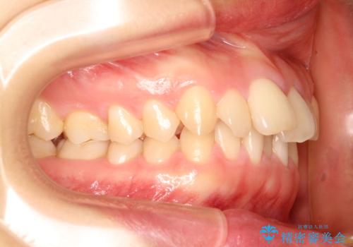 【出っ歯(飛び出した前歯)・がたつきでお悩みの方必見】インビザライン矯正の症例の治療前