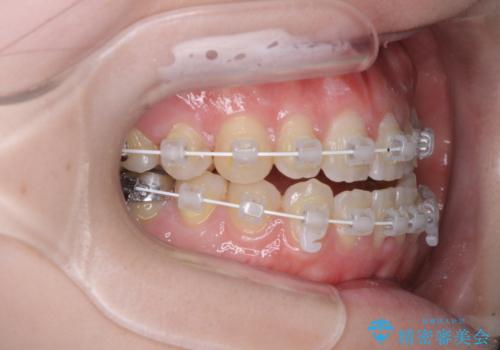 八重歯と前歯の欠損と骨格のズレ 目立たないワイヤー矯正の治療中