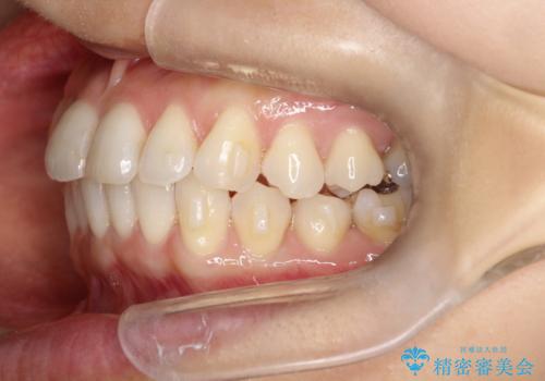 八重歯と前歯のガタガタをインビザラインでの治療中