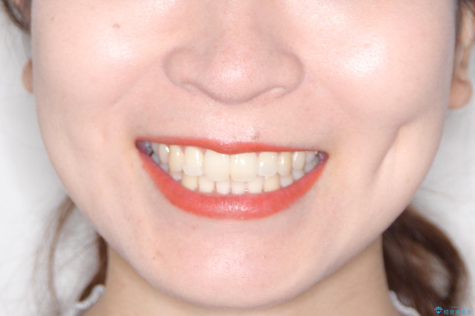【すきっ歯・引っ込んだ前歯でお悩みの方必見】インビザライン矯正の症例の治療後（顔貌）
