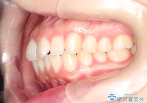 前歯のがたつきをインビザラインで目立たない矯正の治療前