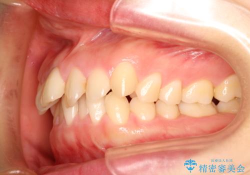 【出っ歯(飛び出した前歯)・がたつきでお悩みの方必見】インビザライン矯正の症例の治療前