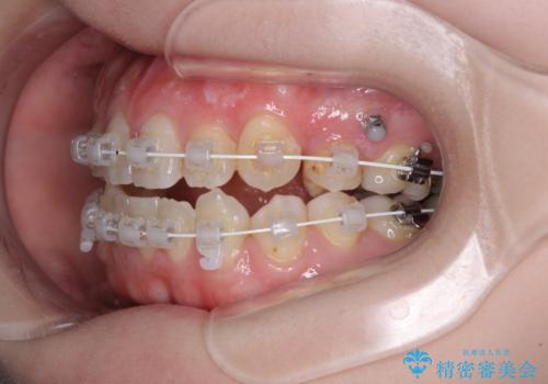 八重歯と前歯の欠損と骨格のズレ 目立たないワイヤー矯正の治療中